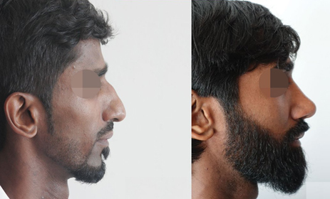 Beard Hair Transplant in Chandigarh