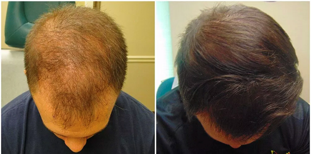 PRP Therapy for Hair Loss Chandigarh