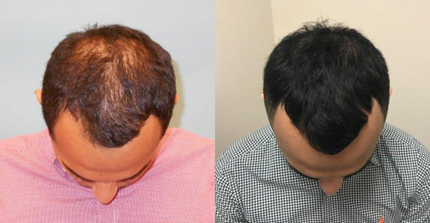 PRP Therapy for Hair Loss Chandigarh