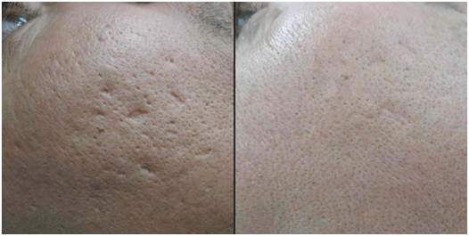 laser-scar-removal-treatment
