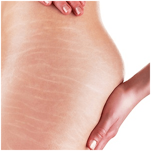 stretch-marks-removal-treatment