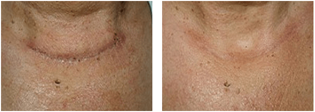 Treatment For Surgical And Traumatic Scars