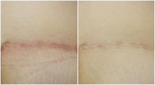 laser-treatment