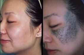 Laser Birthmark Removal: A Comprehensive Guide to Before and After