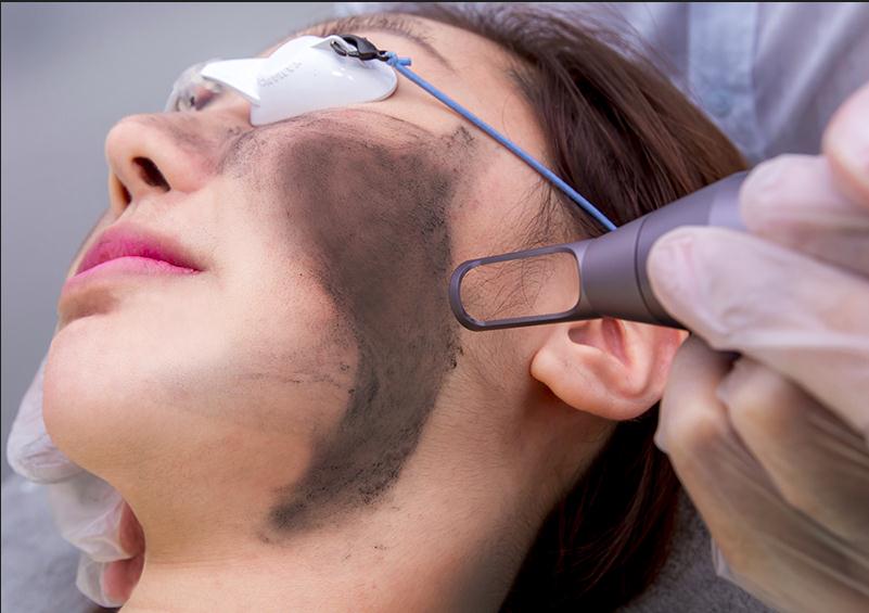 Carbon Peel Removal in Chandigarh Athena Skin Clinic