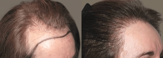 Female FUE Hair Transplant in Chandigarh