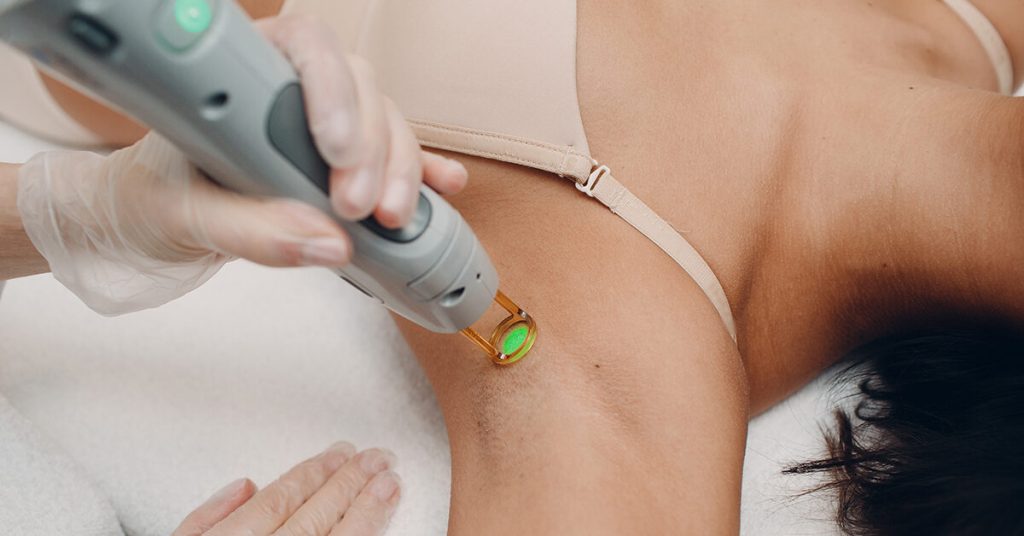 laser hair removal 2