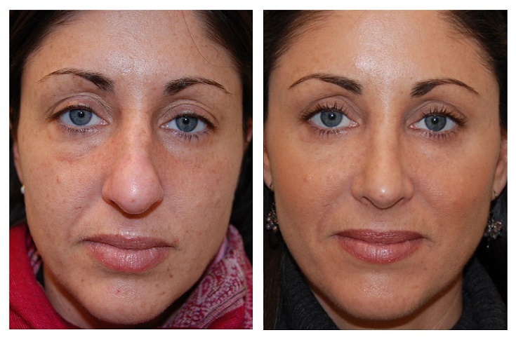 Photofacial clearance