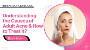 understanding the causes of adult acne