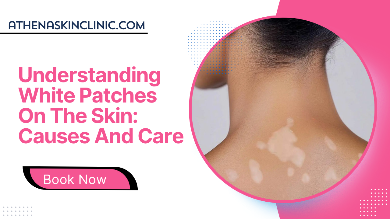 Understanding White Patches