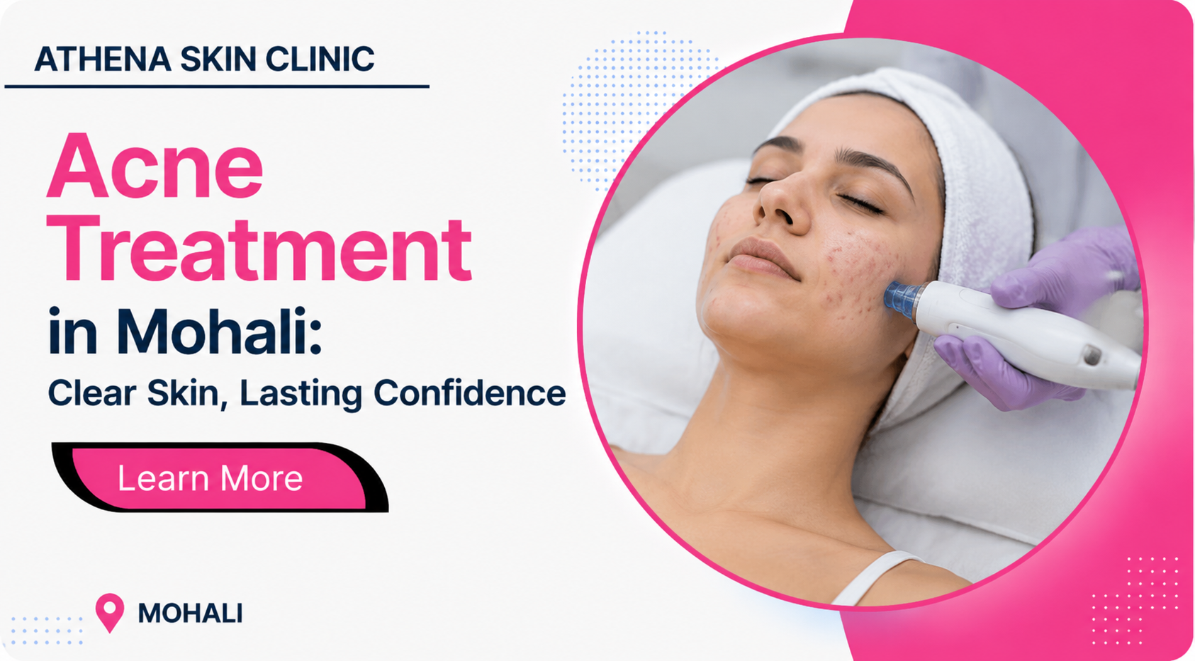Acne Treatment in Mohali by Athena skin clinic