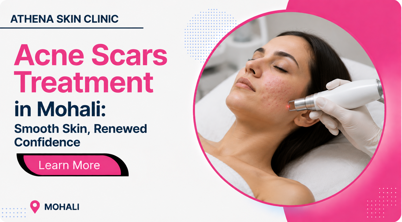 acne scars in mohali